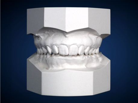 Изготовление гипсовой модели. Гипсовая модель зубов. Гипсовые модели челюстей. Модели стоматологические гипсовые. Гипсовая модель нижней челюсти.